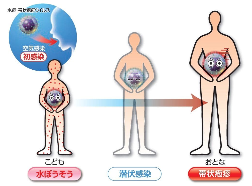 水疱・帯状疱疹ウイルスの進行